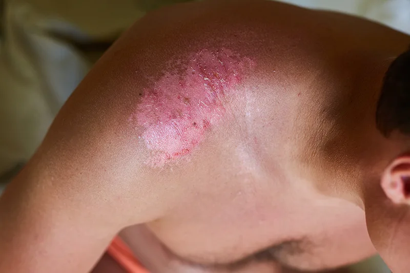 Domowe sposoby na poparzenia słoneczne, jak złagodzić oparzenie słoneczne? Podpowiadamy!